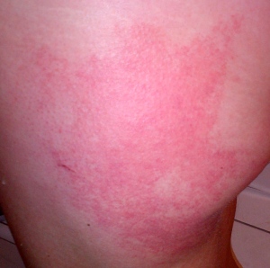 Do not adjust your screen. That is not a ham hock. That is a cold rash on what my kids and I call my buttoxes.